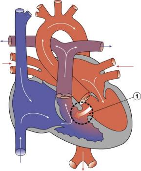 Diagram 2.6 - Ventricular Septal Defect