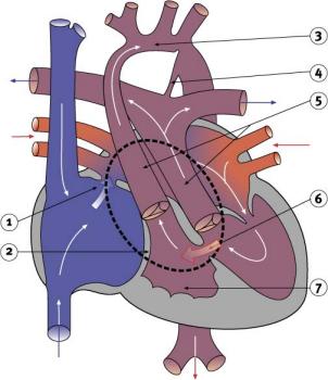 Diagram 2.20 - Functional hypoplastic left heart syndrome