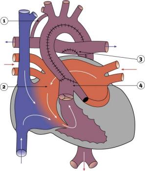 Diagram 2.21 - stage 1 of hypoplastic left heart syndrome reconstruction